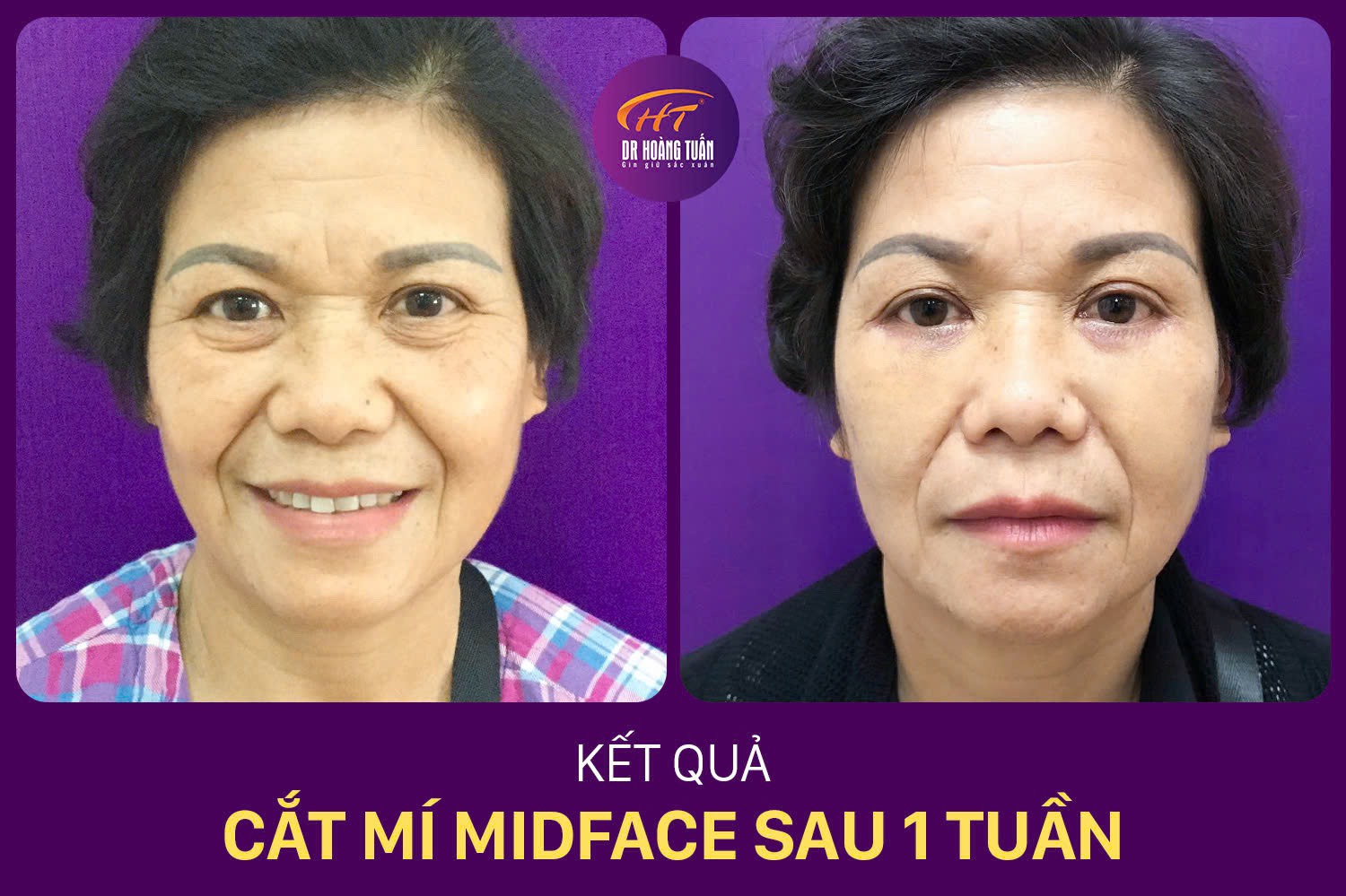 Kết quả cắt mí Midface 